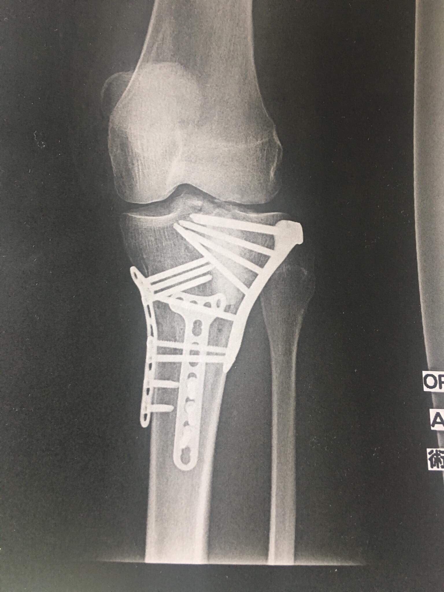 Tibial Plateau Fracture Classification Tibial Plateau Fracture 4482