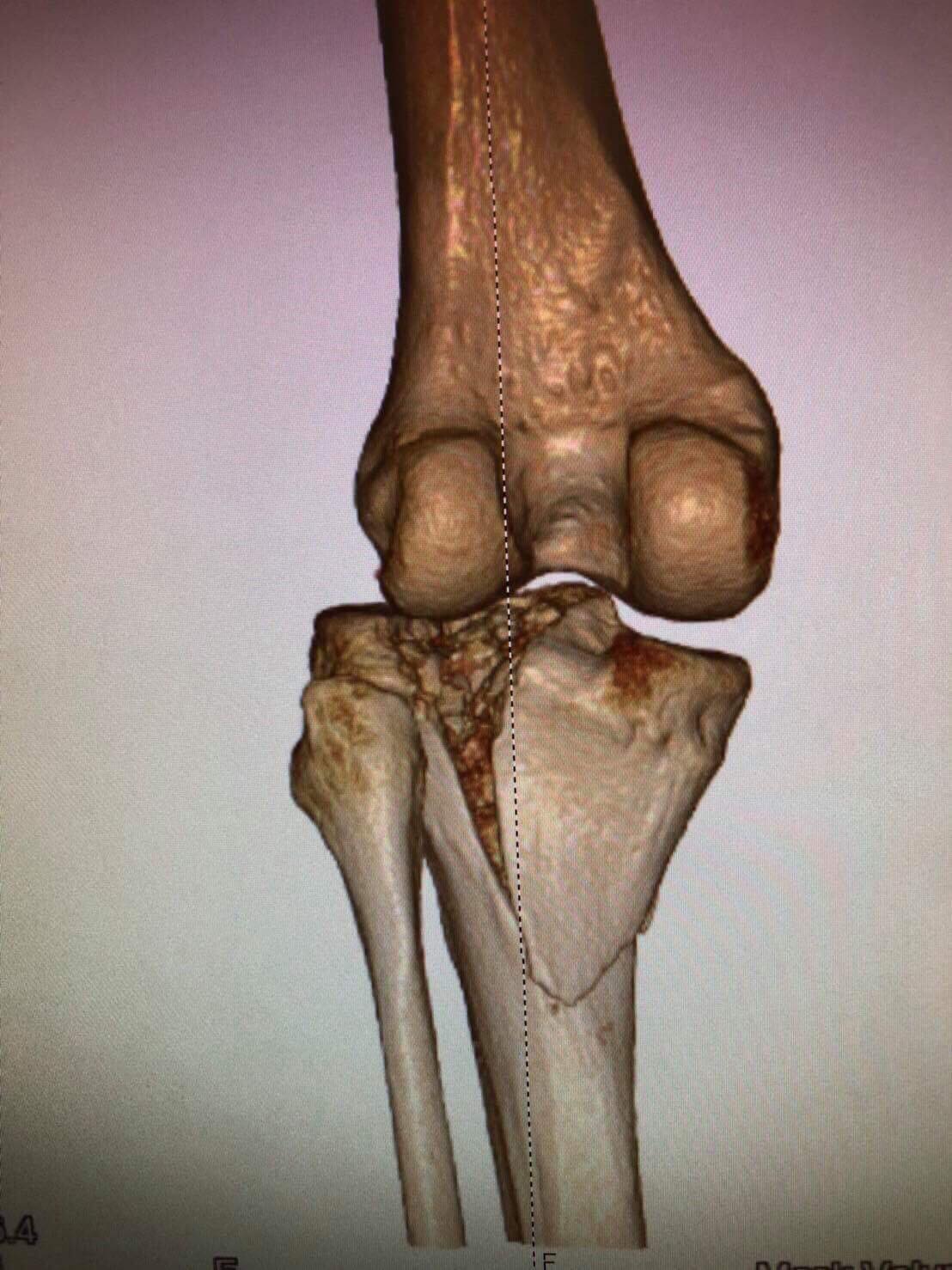 Tibial Plateau Fractures What Are They And How They Can Be Treated